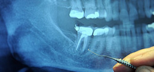 tooth cavities and heart disease