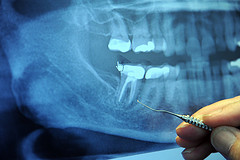 tooth cavities and heart disease