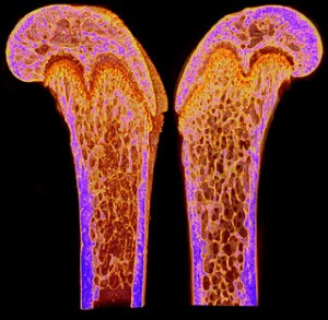 osteoporosis and calcium