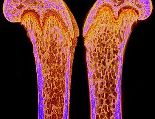 osteoporosis and calcium