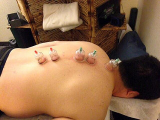 cupping decreases pain and fibromyalgia