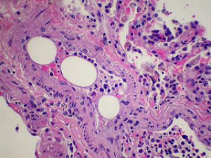 Fat embolism. Image from Yale Rosen