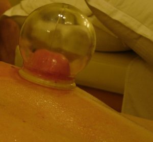 cupping treats over 33 medical conditions