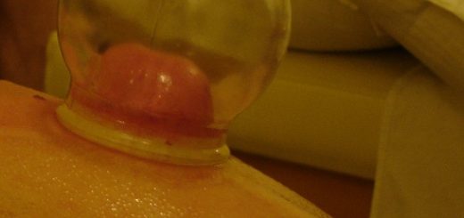 cupping treats over 33 medical conditions