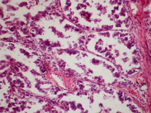 breast cancer linked to bacteria